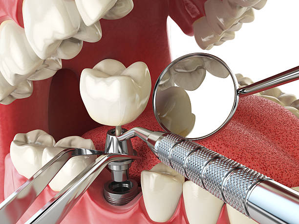 Best Emergency Treatment for Dental Infections or Abscesses in Country Squire Lakes, IN